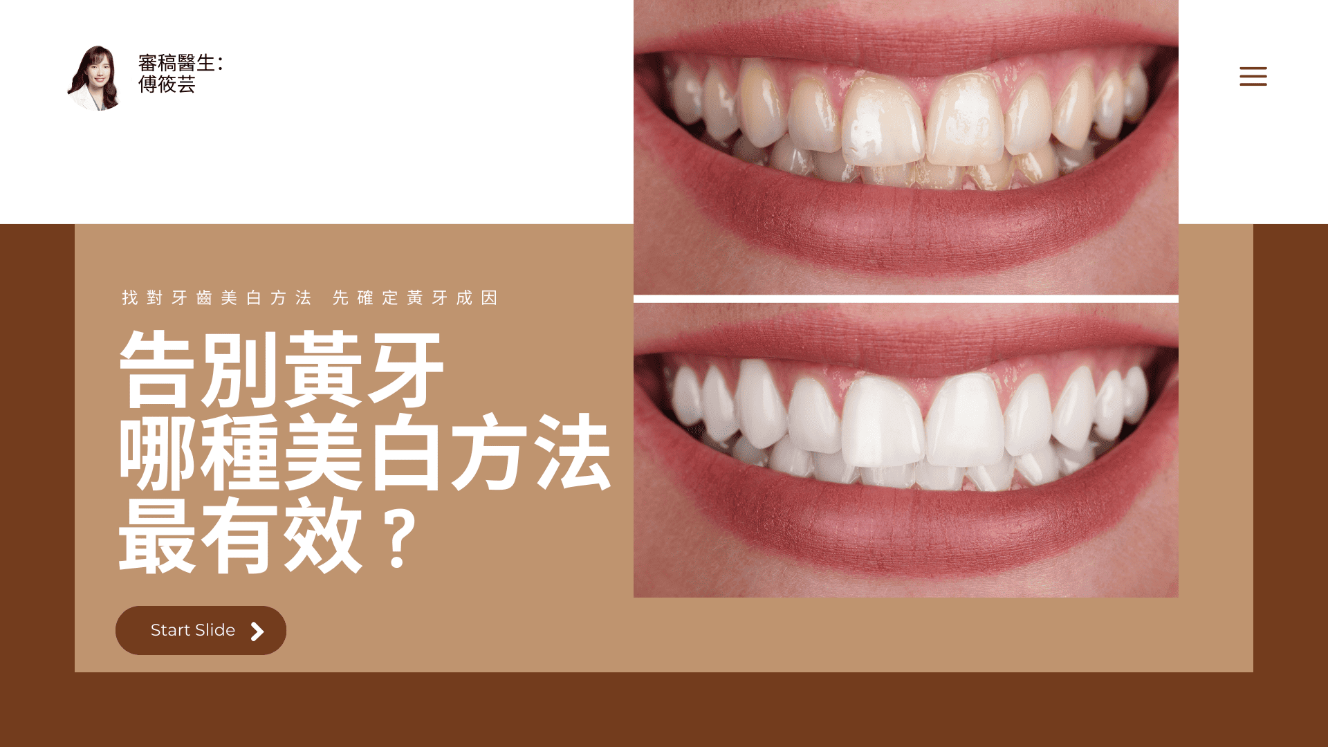 告別黃牙，哪種美白方法最有效？